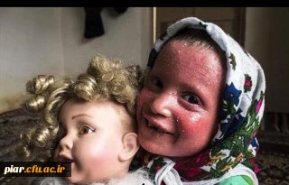 گزارش جمع آوری کمک برای کودک بیمار پوستی