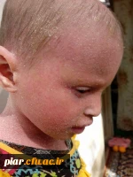 بیماری نرگس رسولی رو به بهبودی است