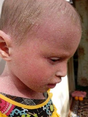 بیماری نرگس رسولی رو به بهبودی است